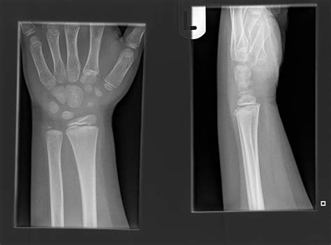 right radius fracture icd 10|icd 10 nonunited fracture arising from distal radius.